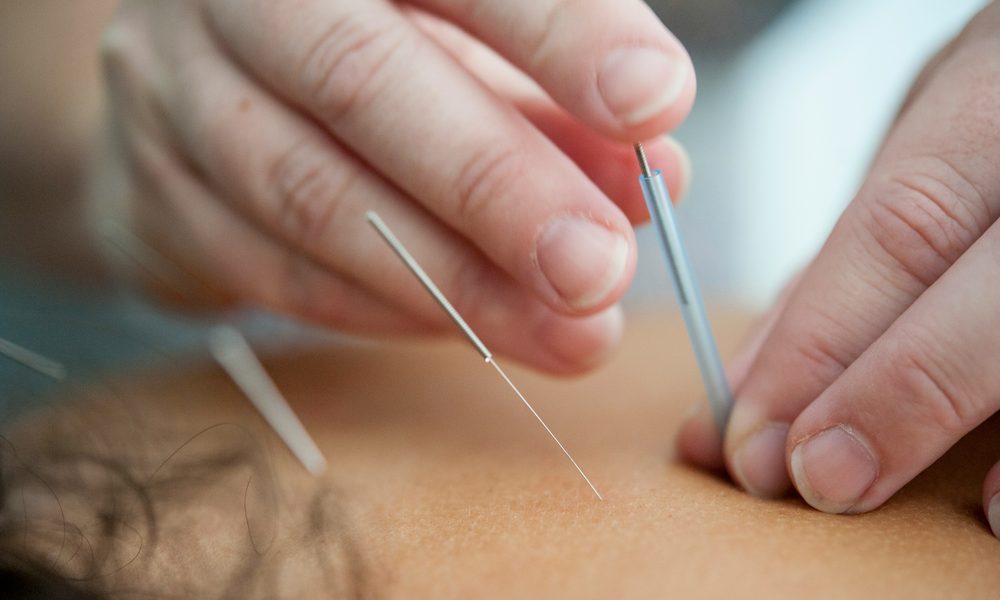 Acupuncture treatment at THE WAY Chiro in Oakville